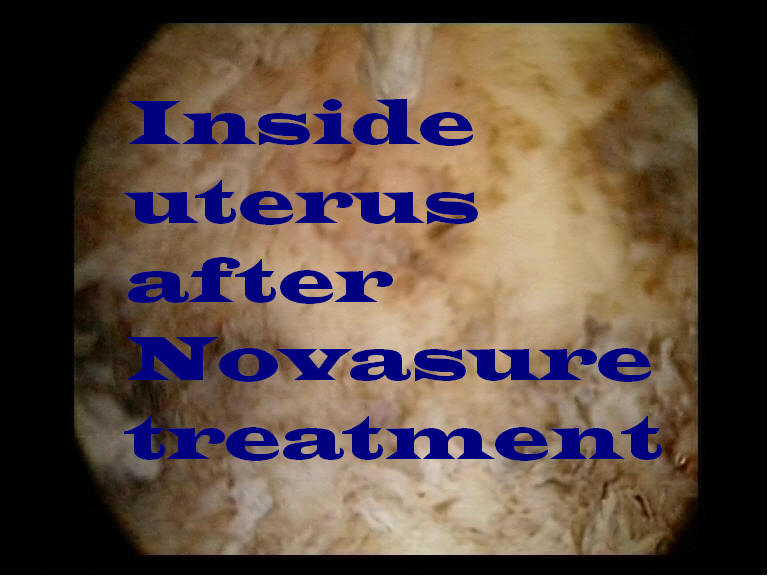 Novasure Endometrial Ablation Dr Serag Youssif